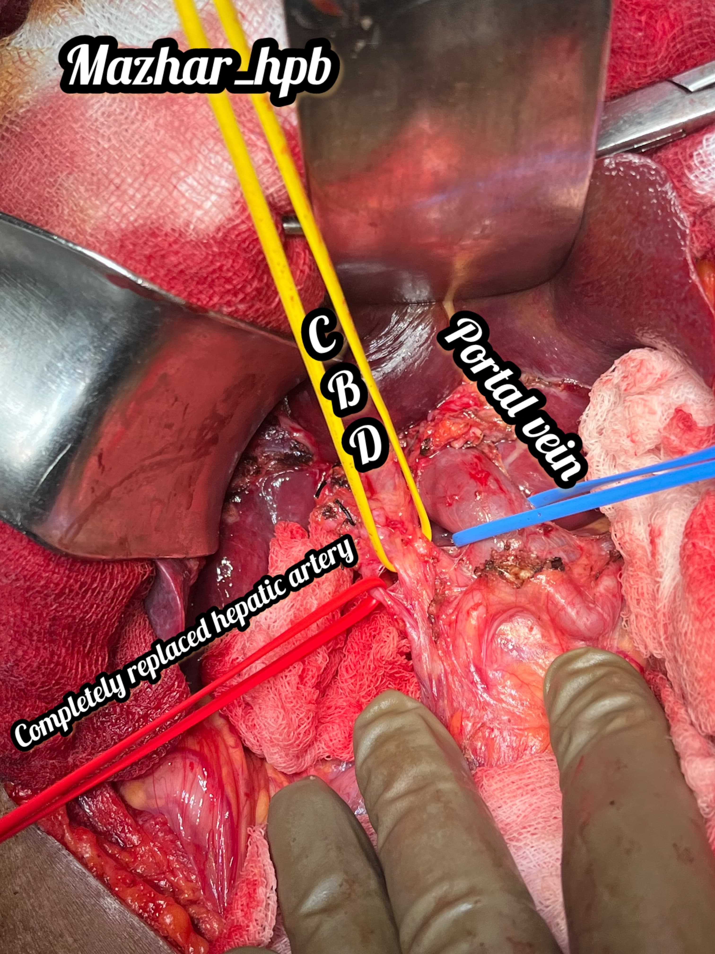 Gall bladder cancer surgery