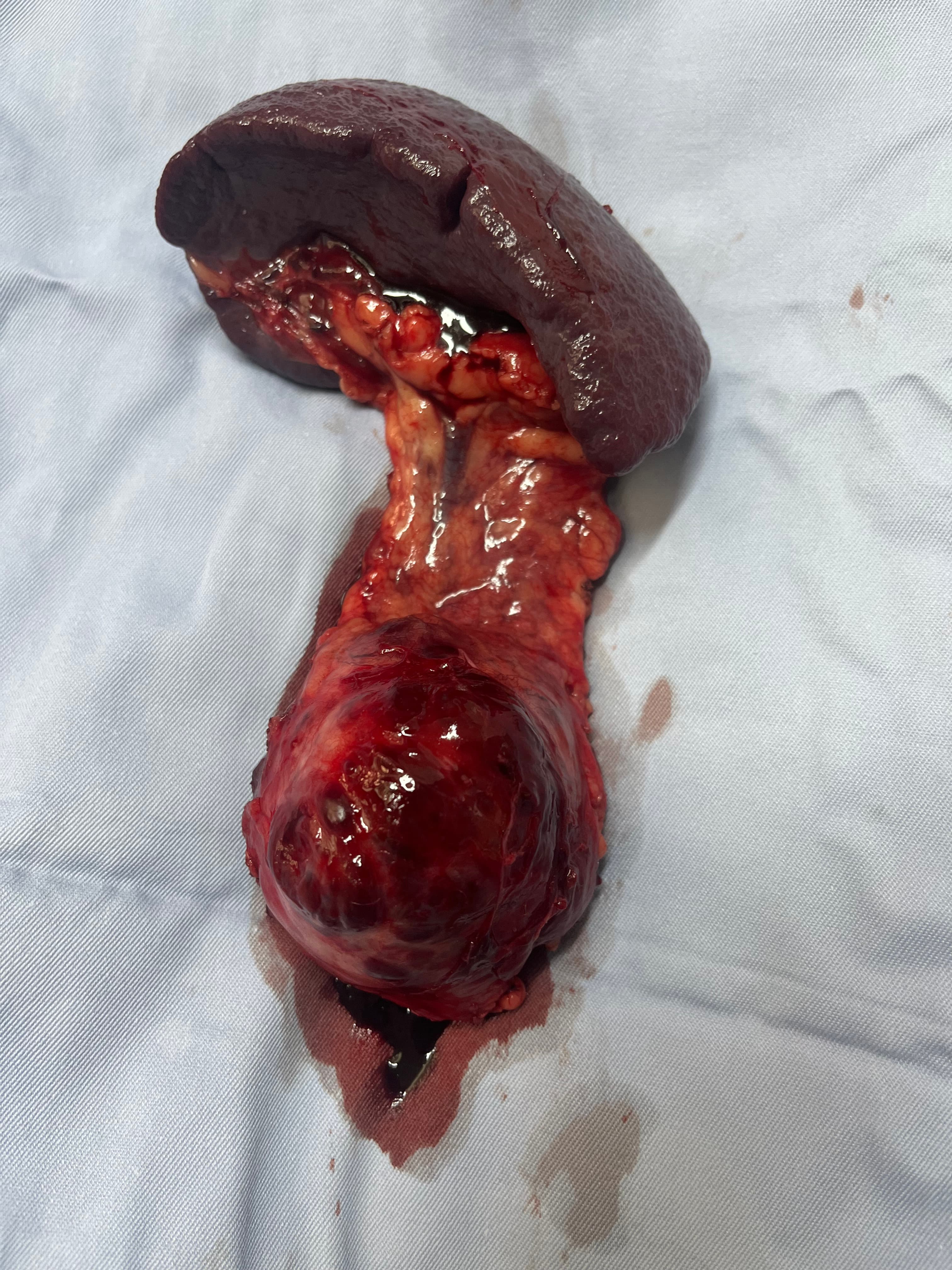 Pancreatic tumiur surgery