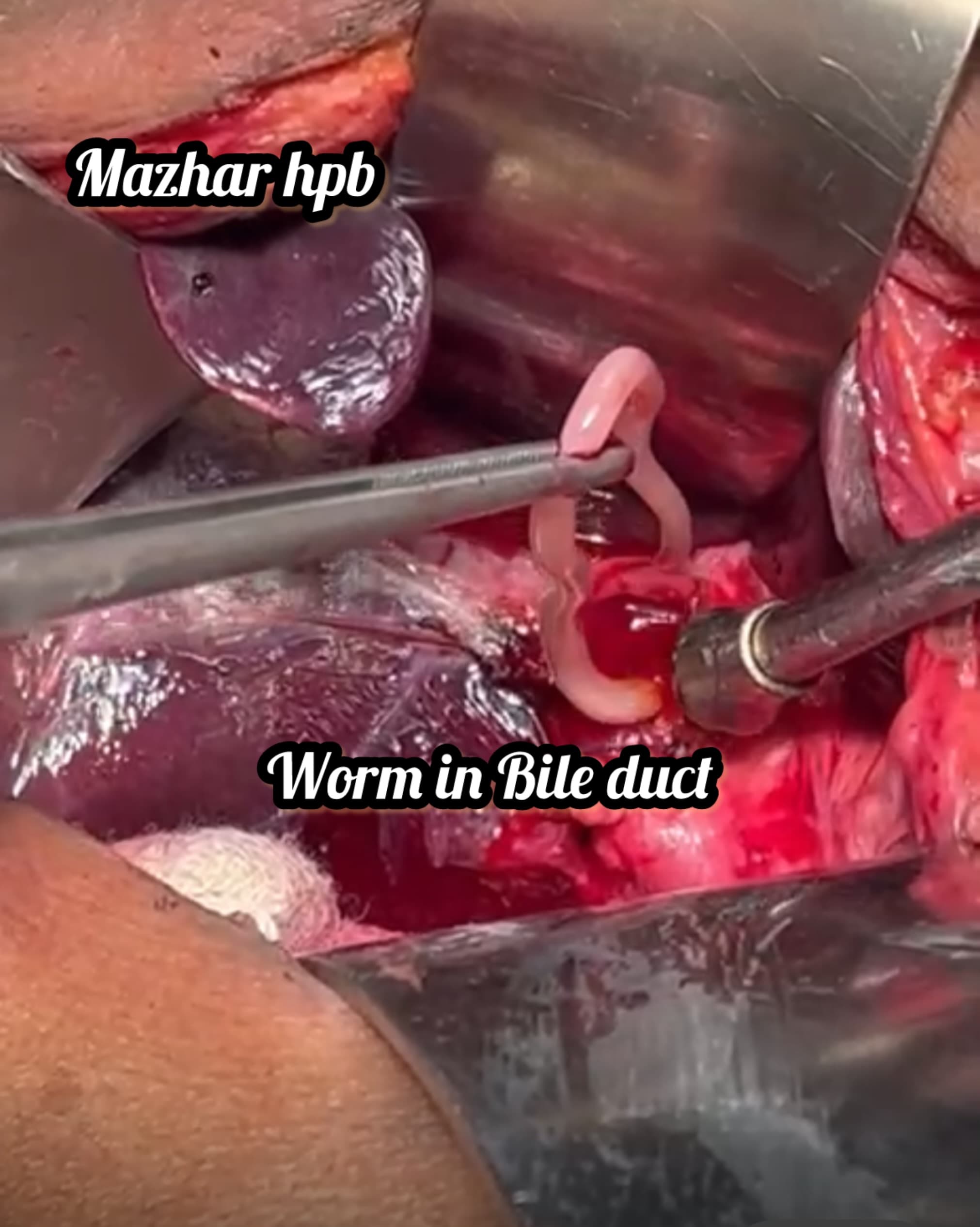 Worm in Common Bile duct