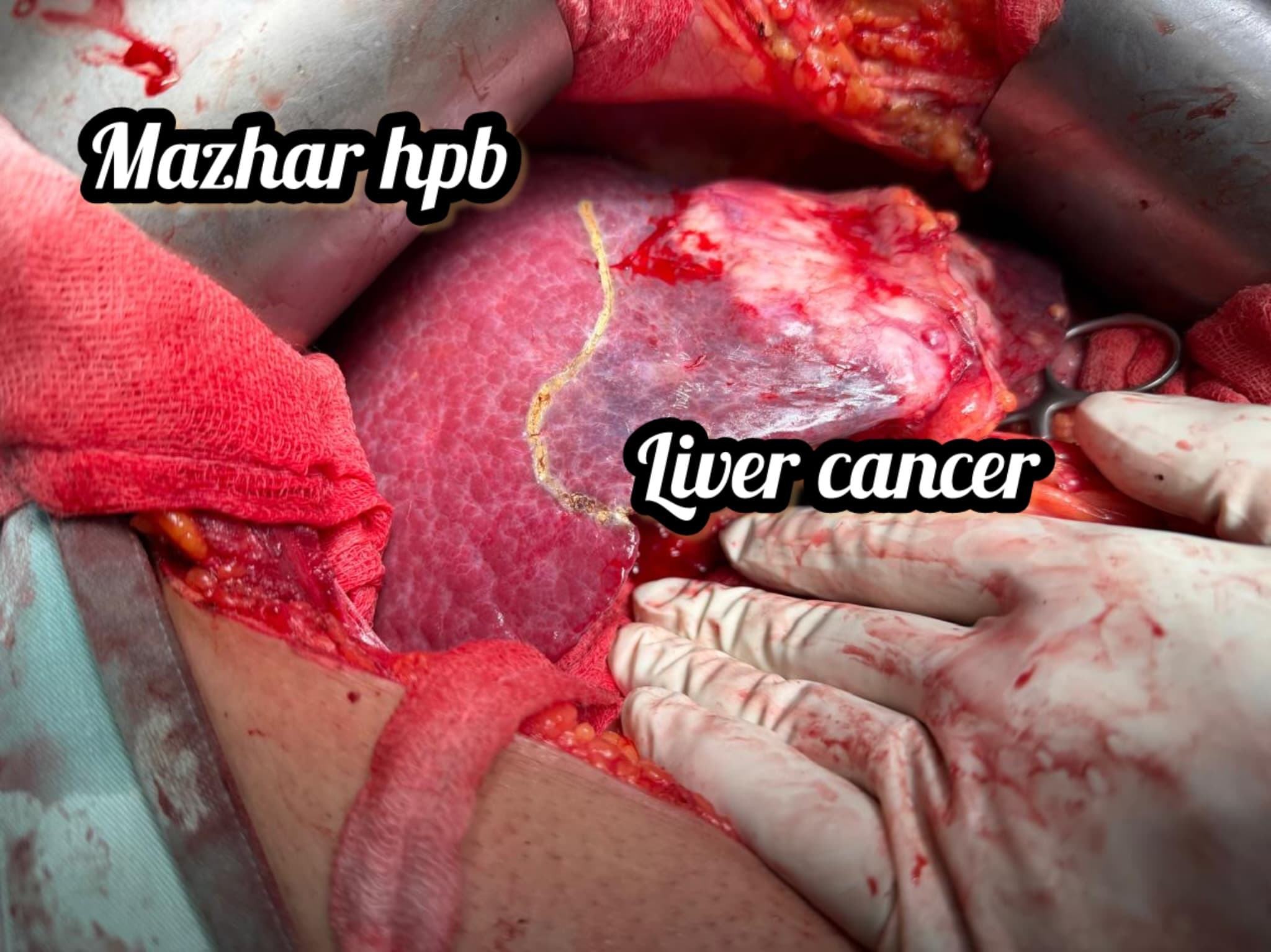Liver cancer surgery