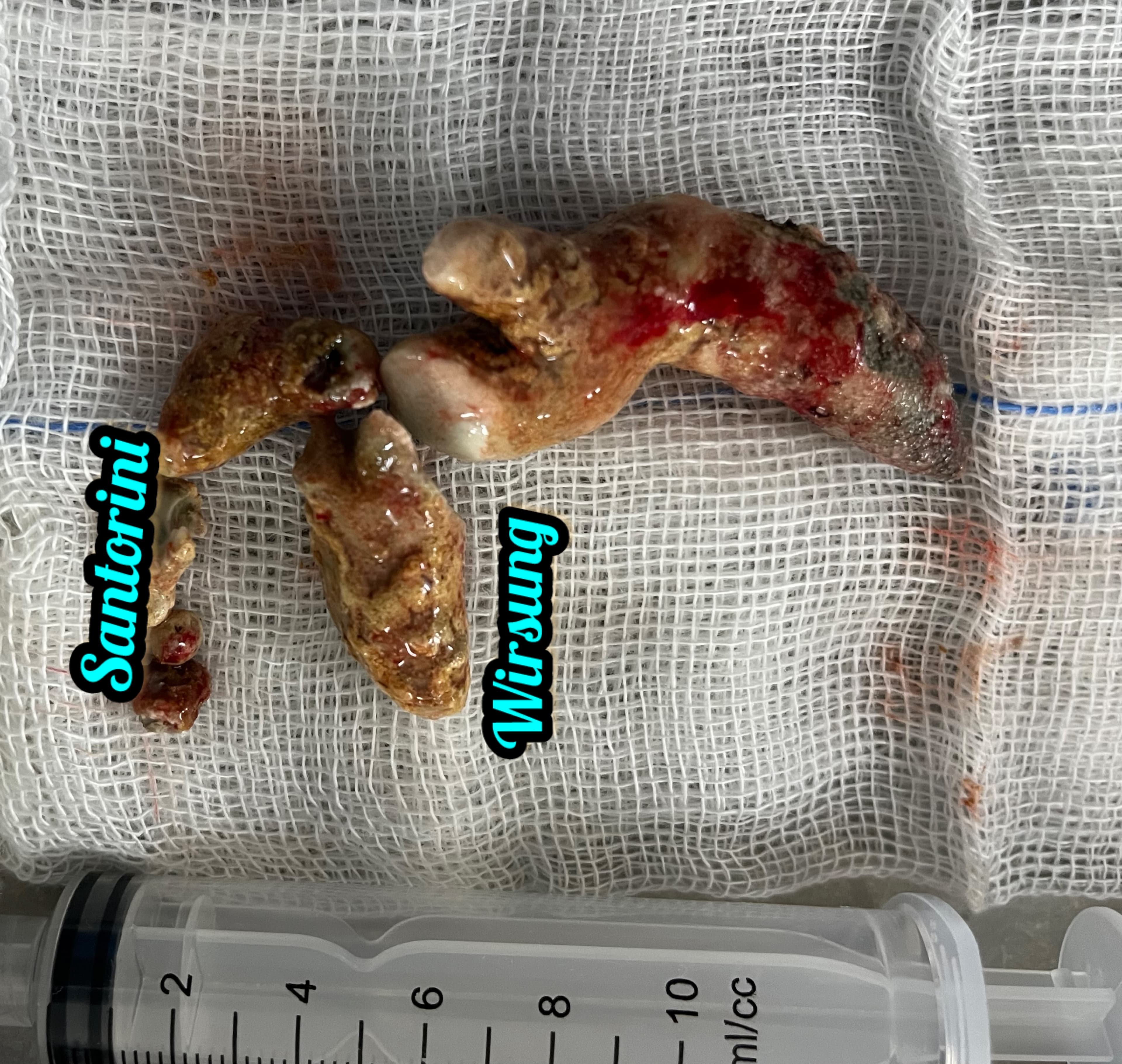 Pancreatic stone surgery