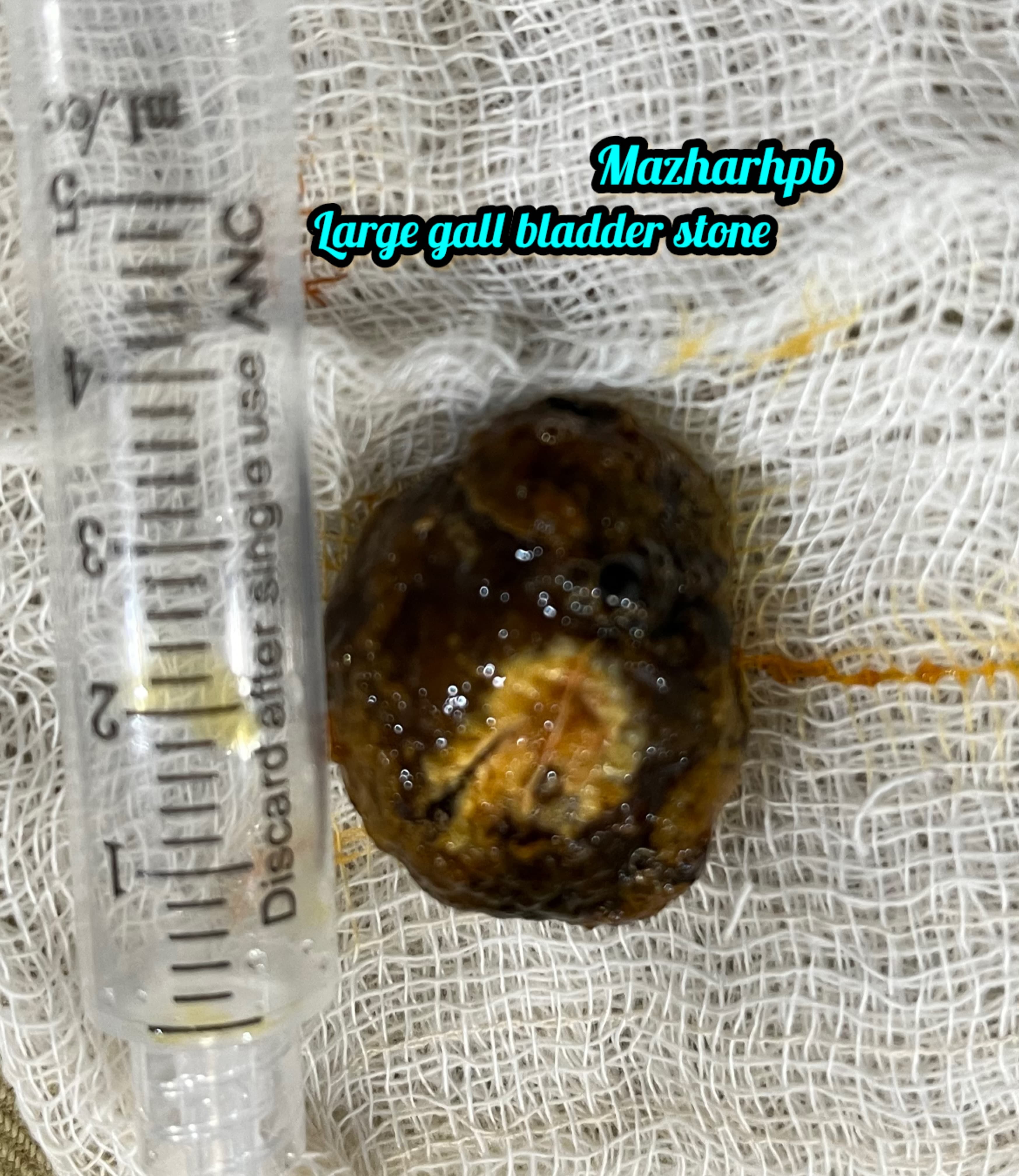 3.5 cm huge gall bladder stone