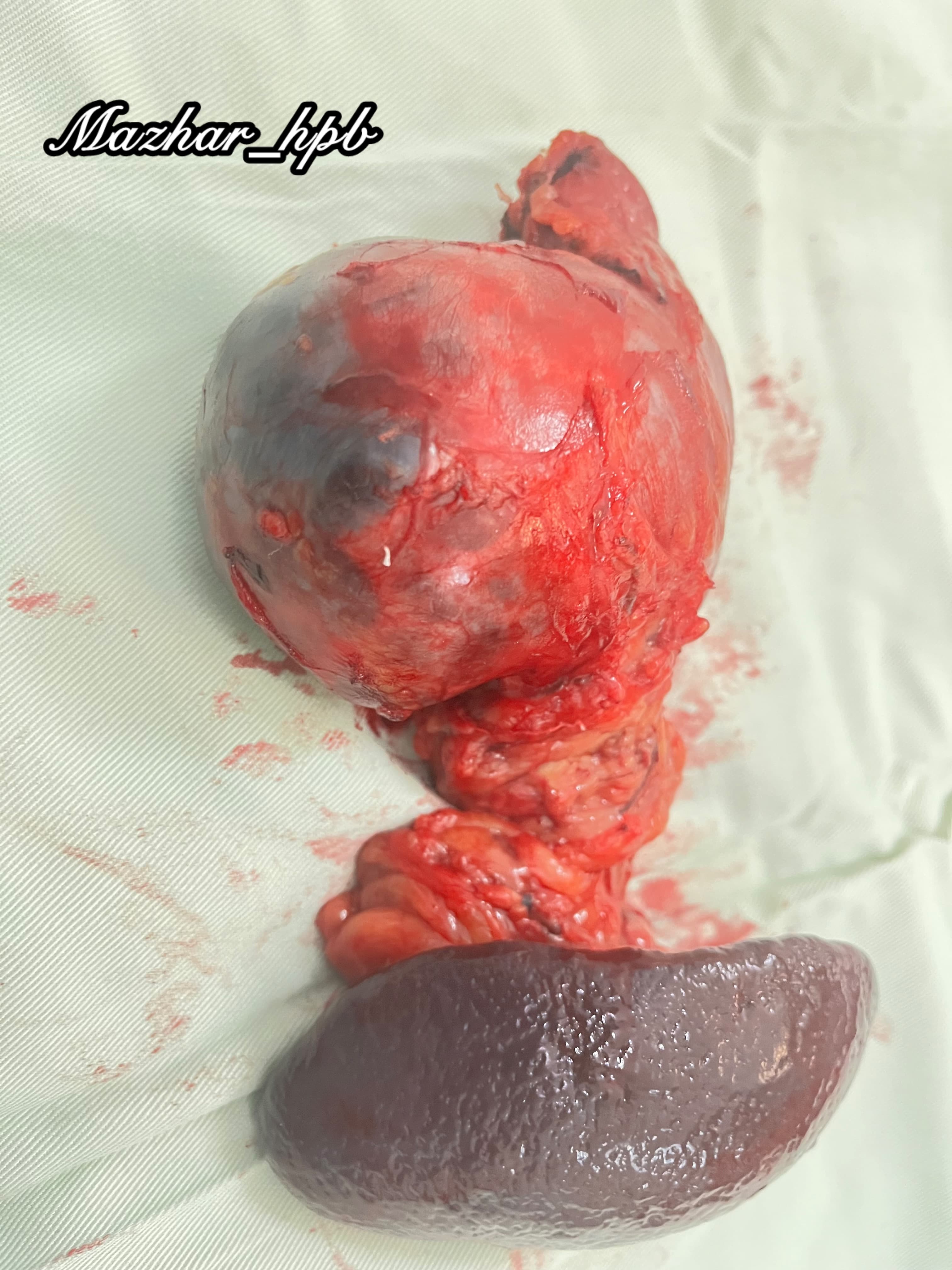 Pacreatic cancer surgery