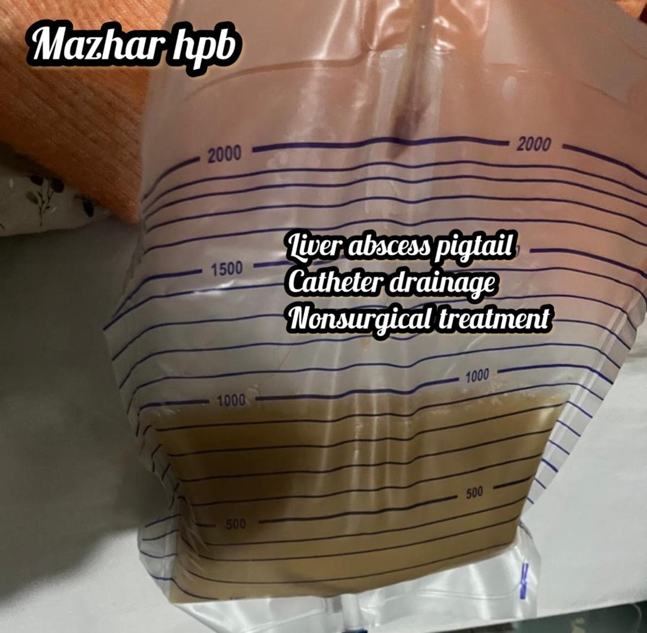 clinical liver abscess drainage