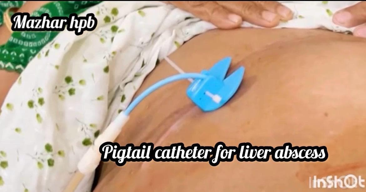 clinical pigtail catheter liver abscess
