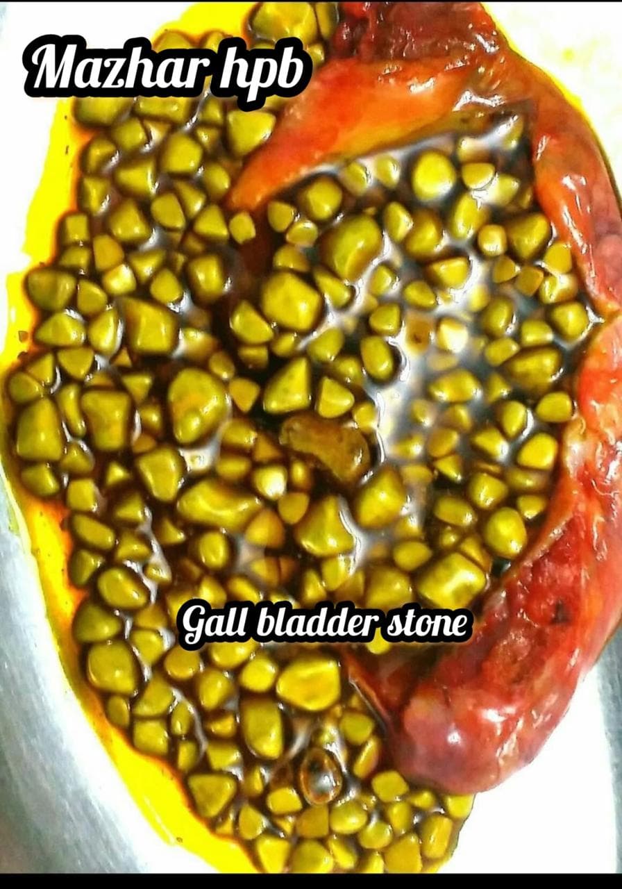 specimen gallbladder stones