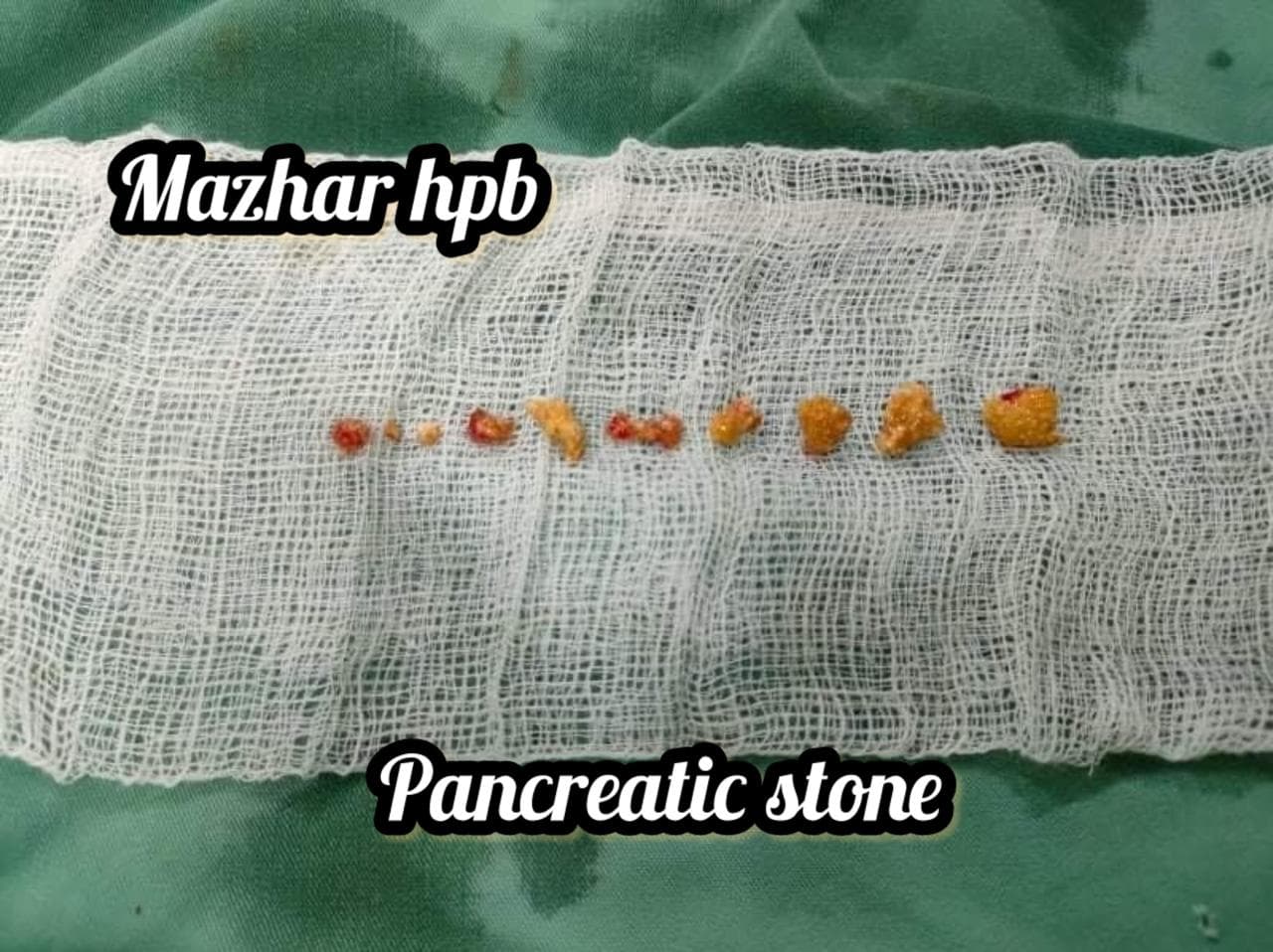 specimen pancreatic stones