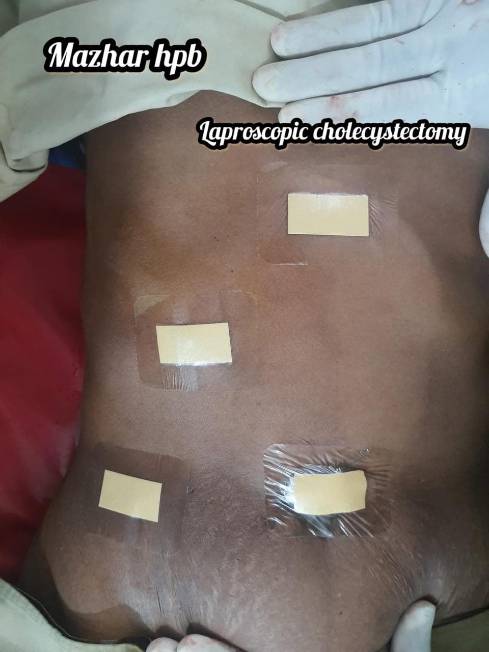 surgery laparoscopic cholecystectomy